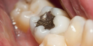 Amalgam fillings are safe for most people